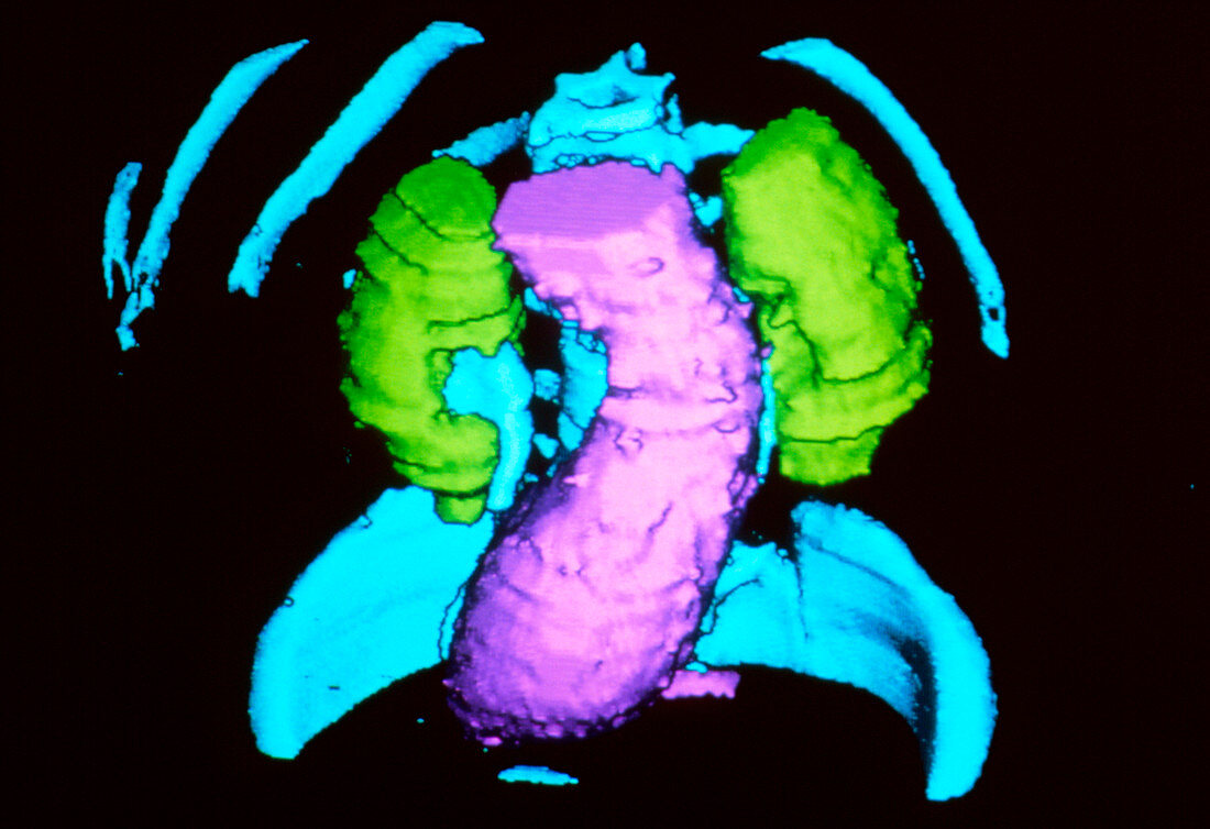 3-D CT scan of abdominal aortic aneurysm