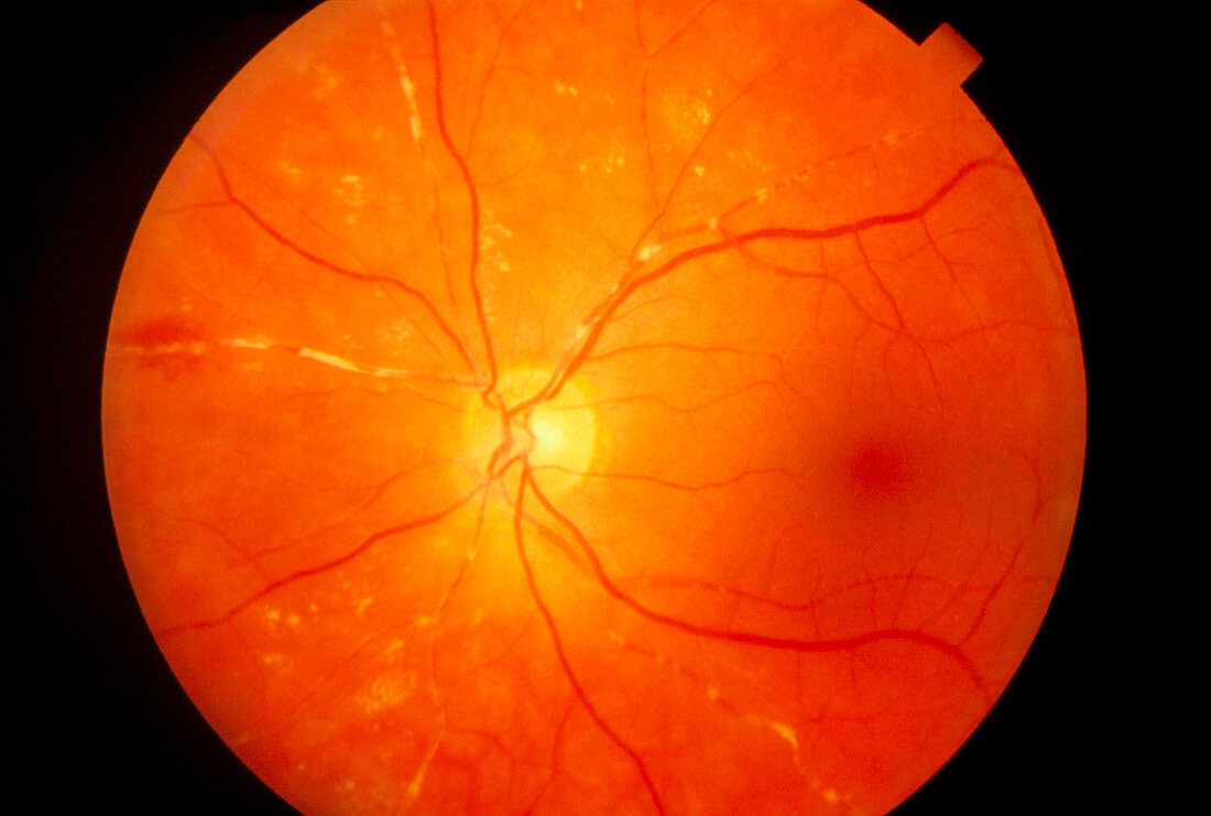 Ophthalmoscopy of retinal embolism in patient eye