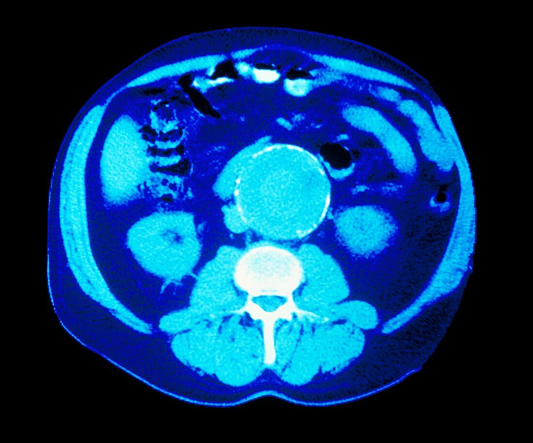Coloured CT scan showing an aortic aneurysm
