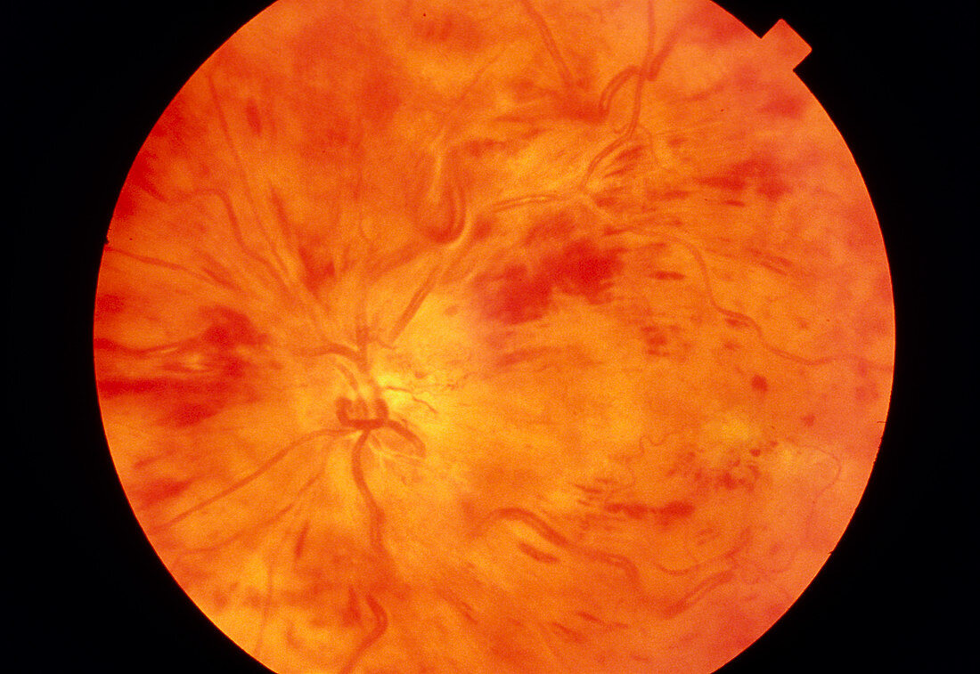 Ophthalmoscopy of occluded Central Retinal Vein