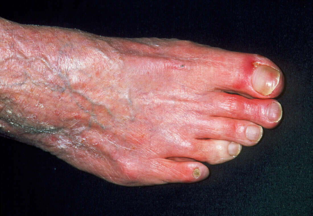 Peripheral vascular disease causing cold 4th toe