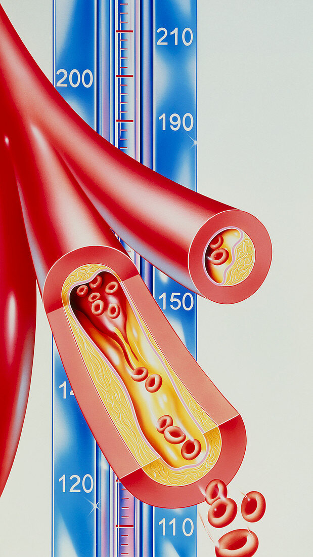 Artwork of atherosclerosis & blood pressure scale