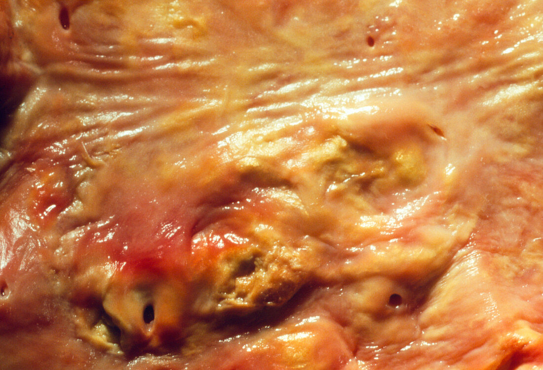 Close-up of atheroma on lining of the human aorta