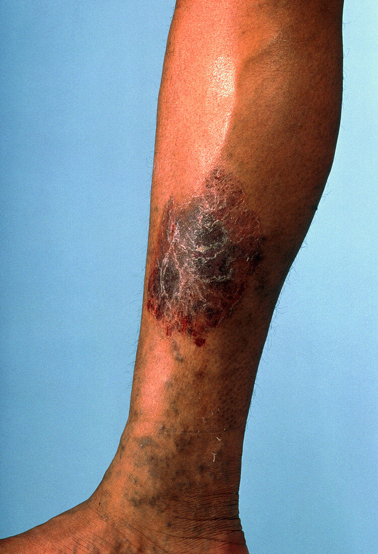 Leg suffering from chronic venous insufficiency
