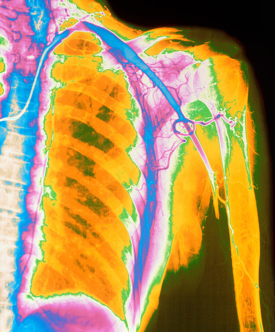 Coloured angiogram of embolus blocking arm artery