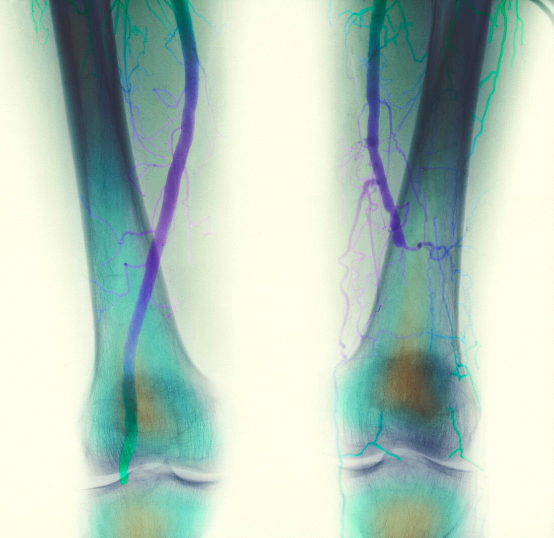 Blocked artery angiogram