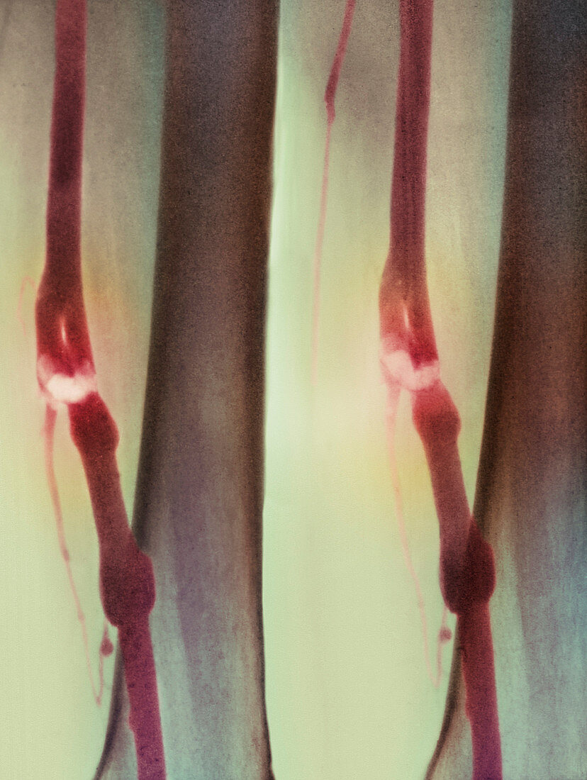 Deep vein thrombosis X-rays