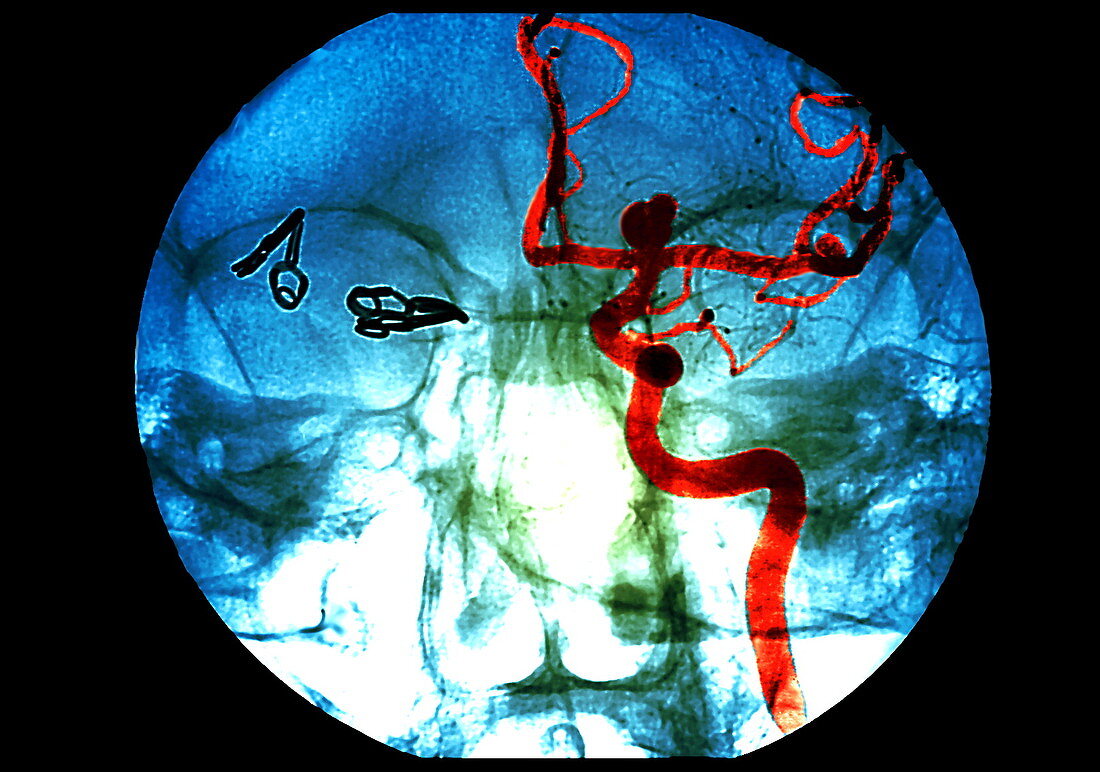 Aneurysm,X-ray