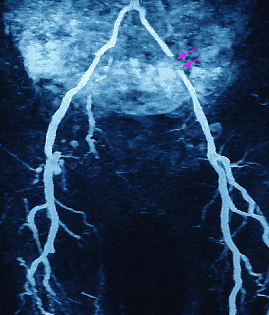 Arterial stent,MRA