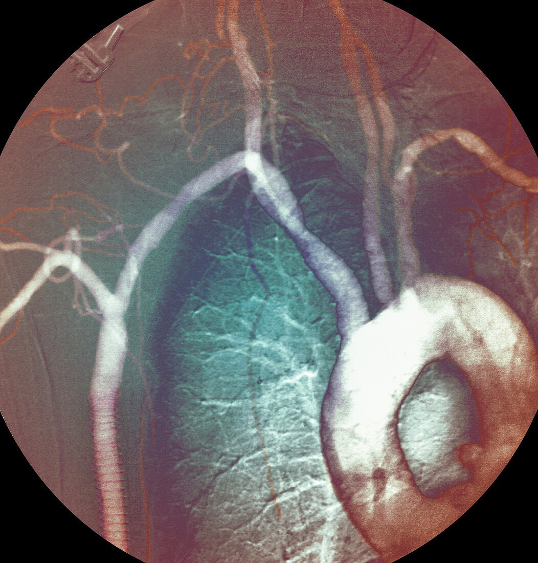 Blood vessel graft,X-ray