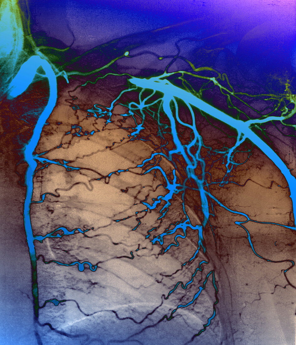 Takayasu's disease,X-ray