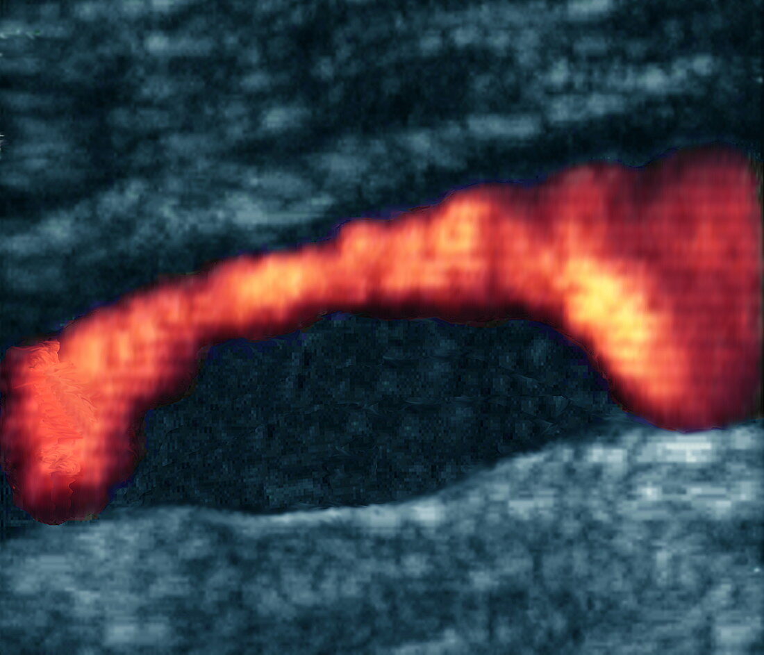 Atheroma plaque,Doppler ultrasound