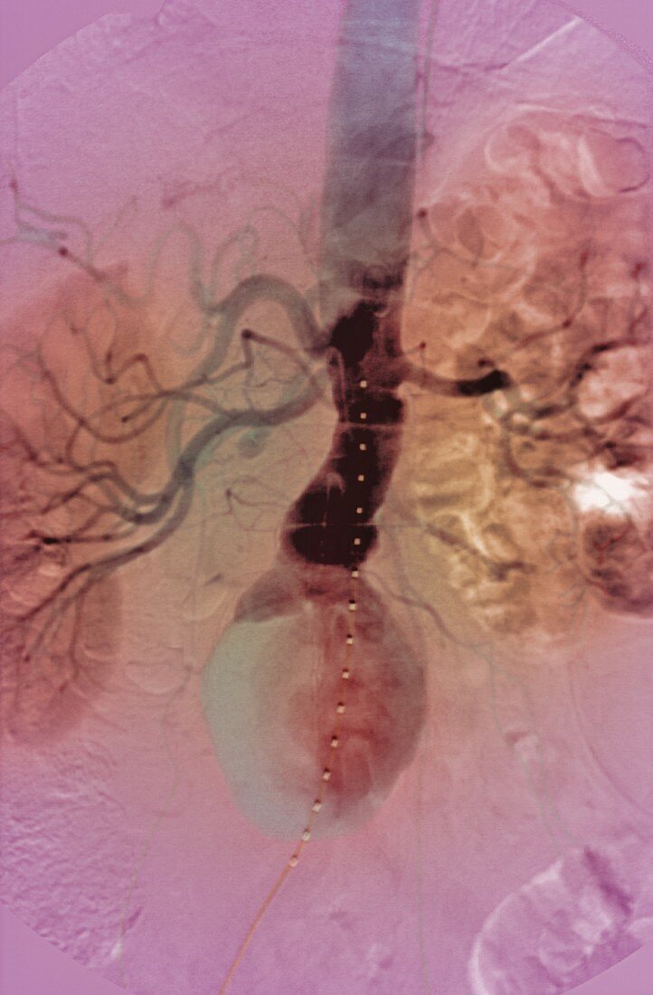 Aortic aneurysm,X-ray