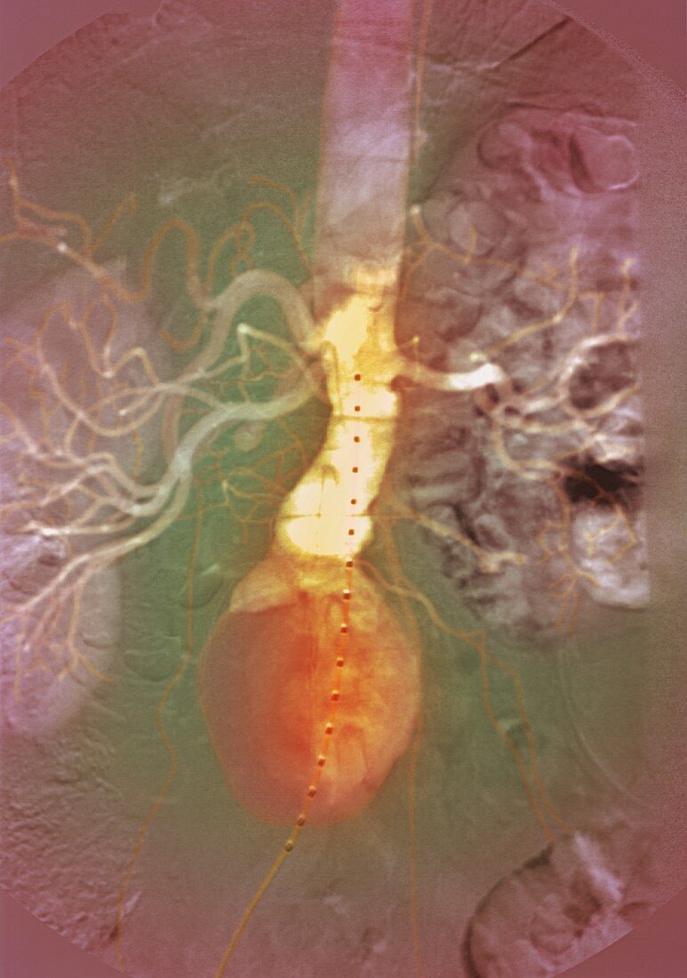 Aortic aneurysm,X-ray
