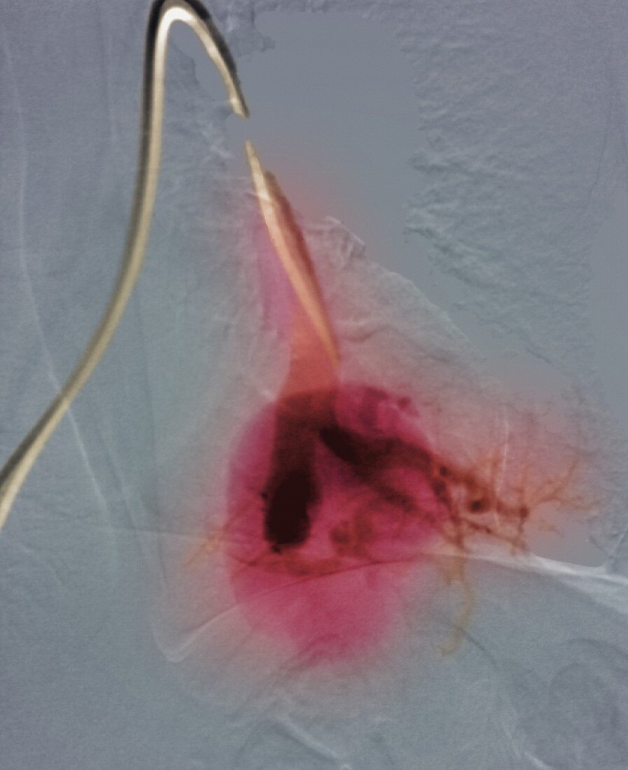 Blood vessel tumour,X-ray