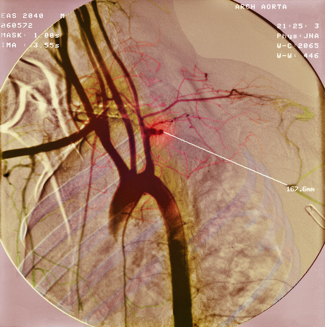 Blocked artery,X-ray