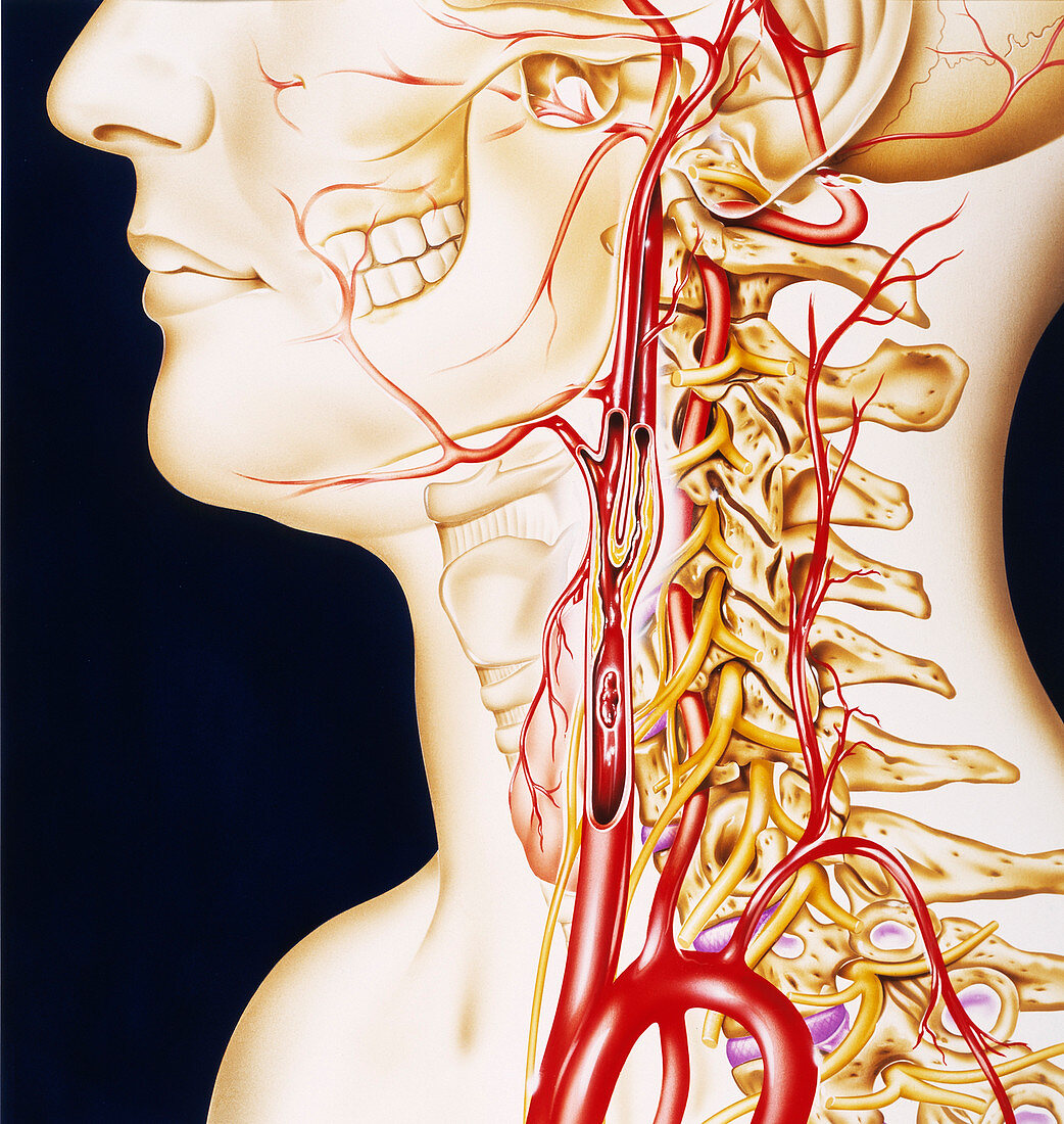 Vascular diseases