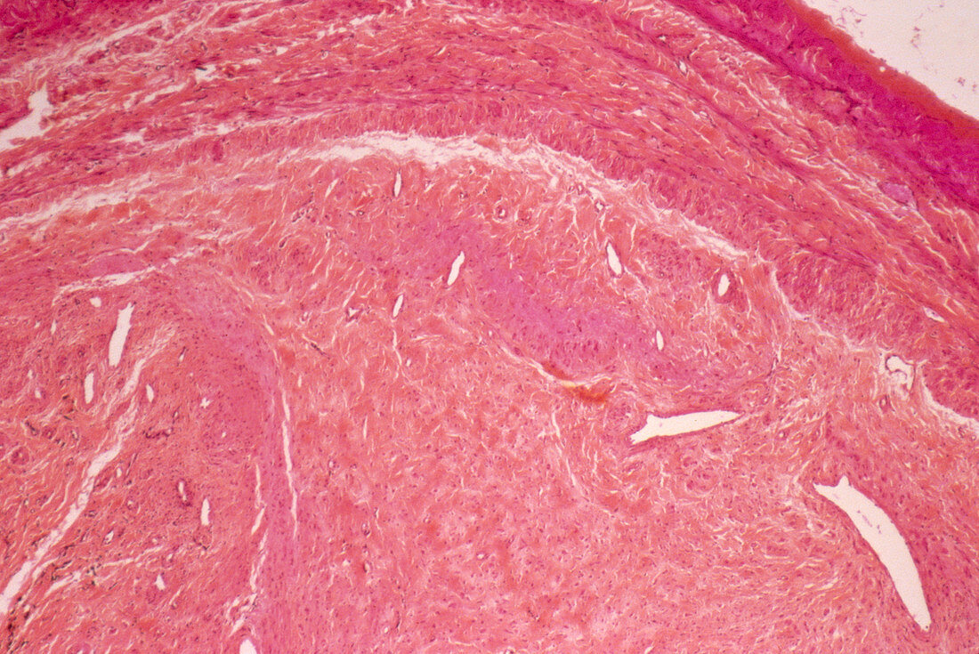 Inflamed vein,light micrograph