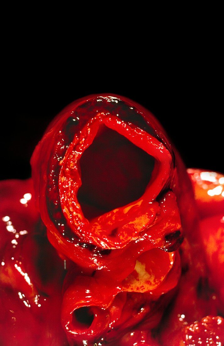 Dissecting aneurysm