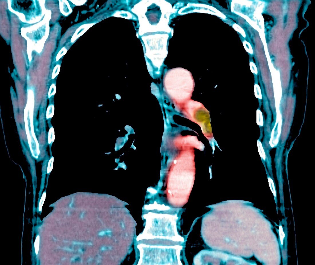 Pulmonary embolism,CT scan