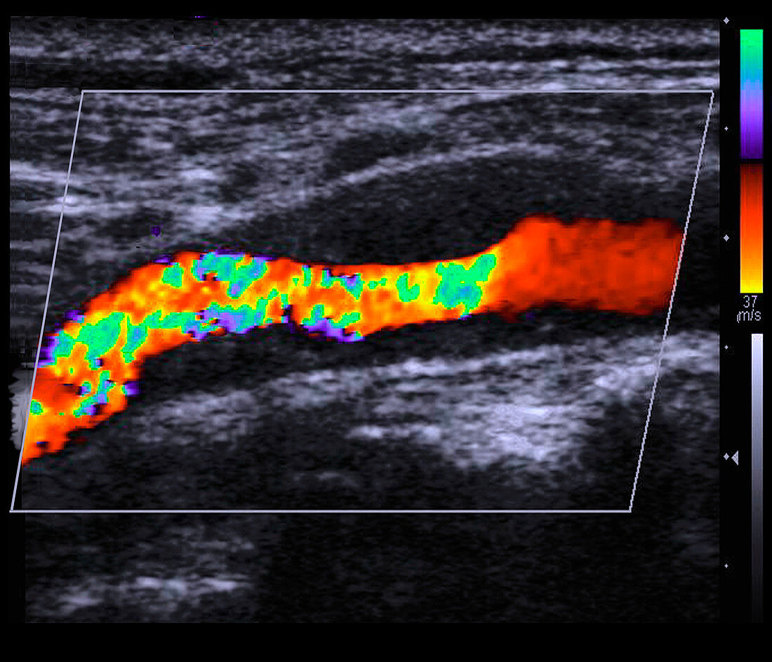 Atheroma plaque,doppler ultrasound