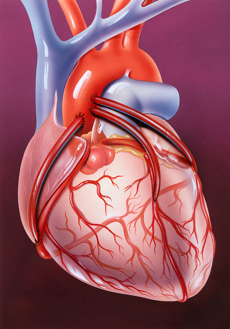 Heart bypass grafts