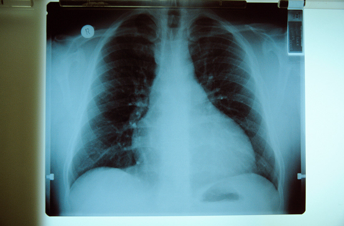 Enlarged heart,X-ray