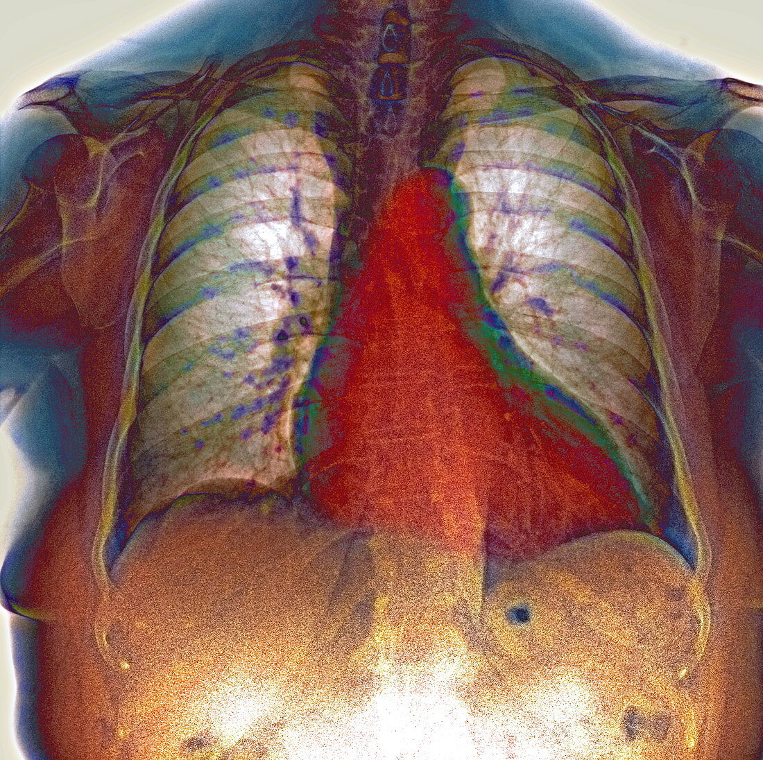 Enlarged heart,X-ray