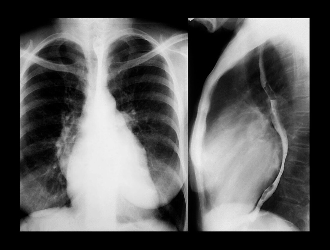 Enlarged heart,X-rays