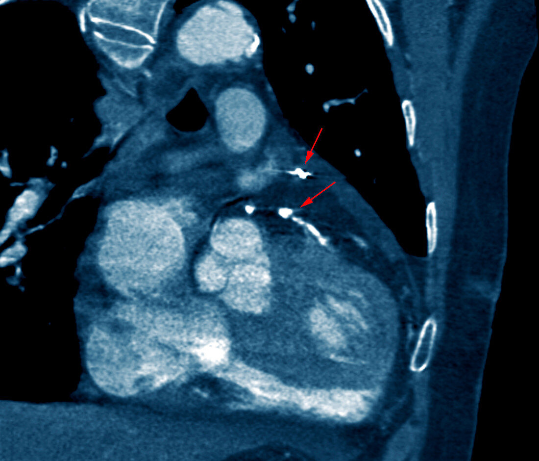 Heart bypass grafts,CT scan