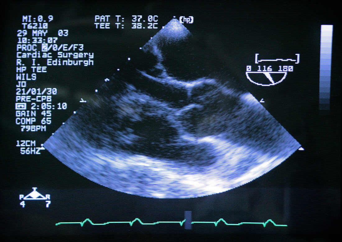 Damaged aortic valve,ultrasound scan