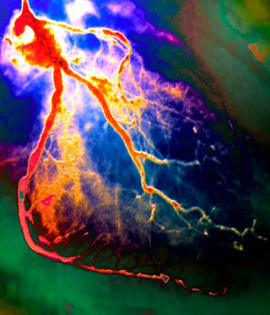 Narrowed coronary arteries,X-ray