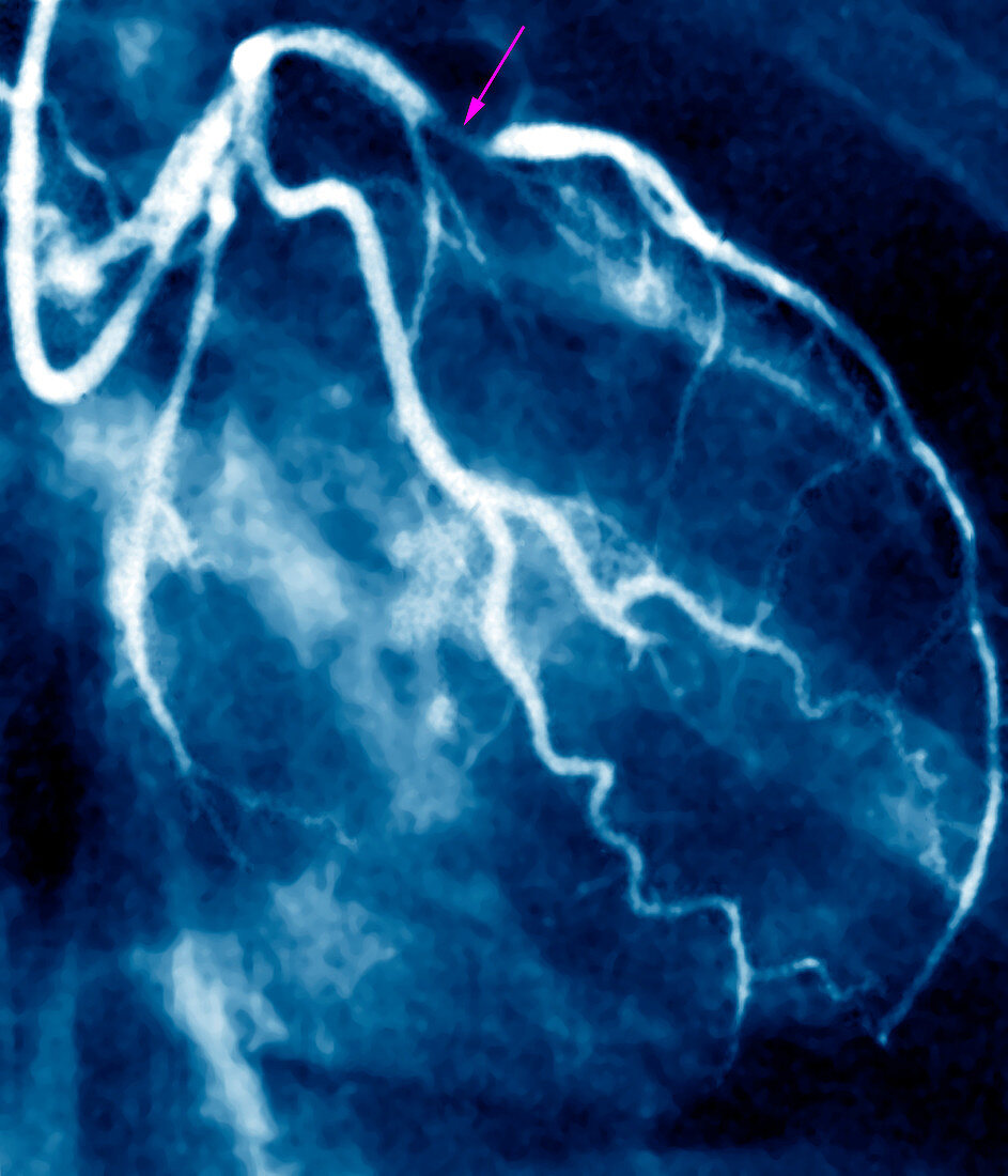 Narrowed coronary artery,X-ray