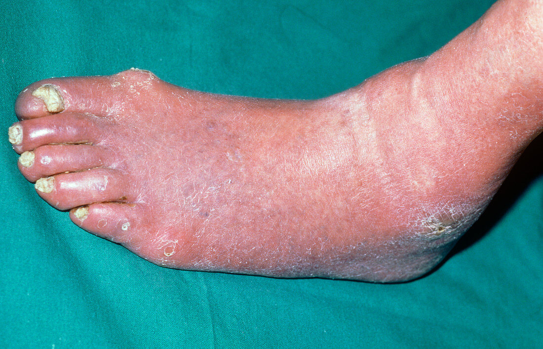 Foot affected by ischaemia
