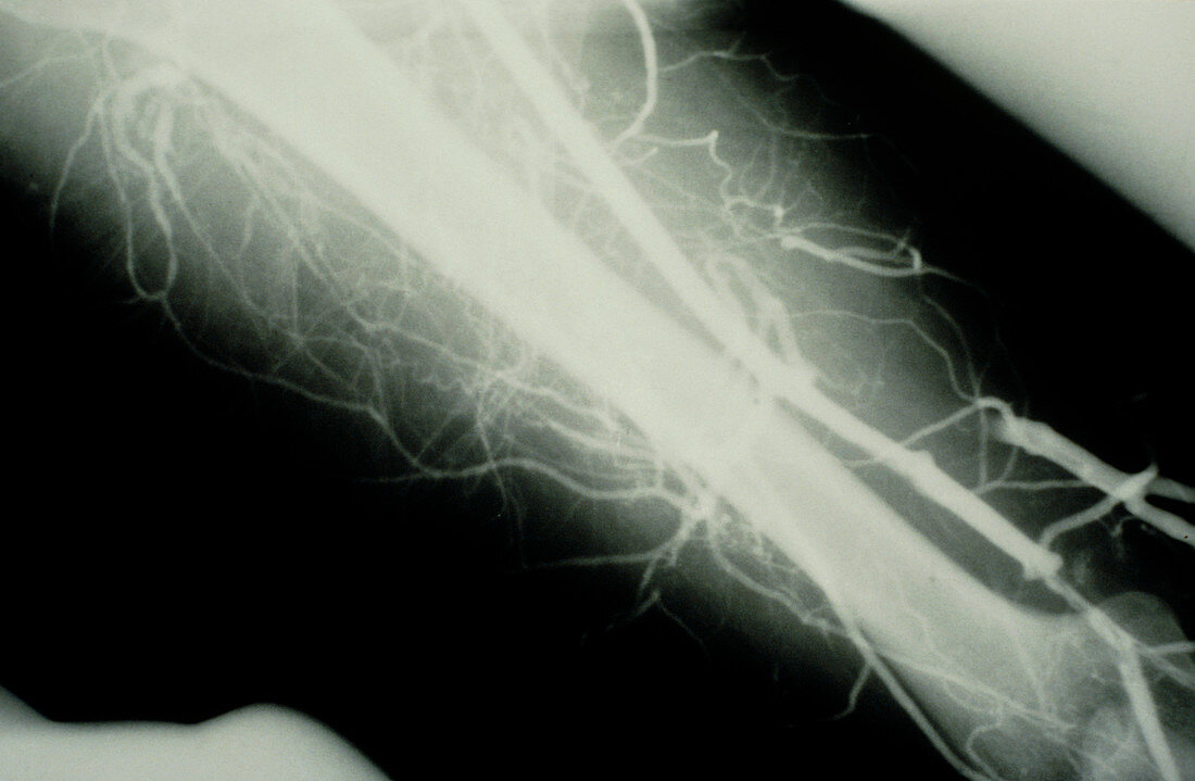 Venogram showing deep vein emboli