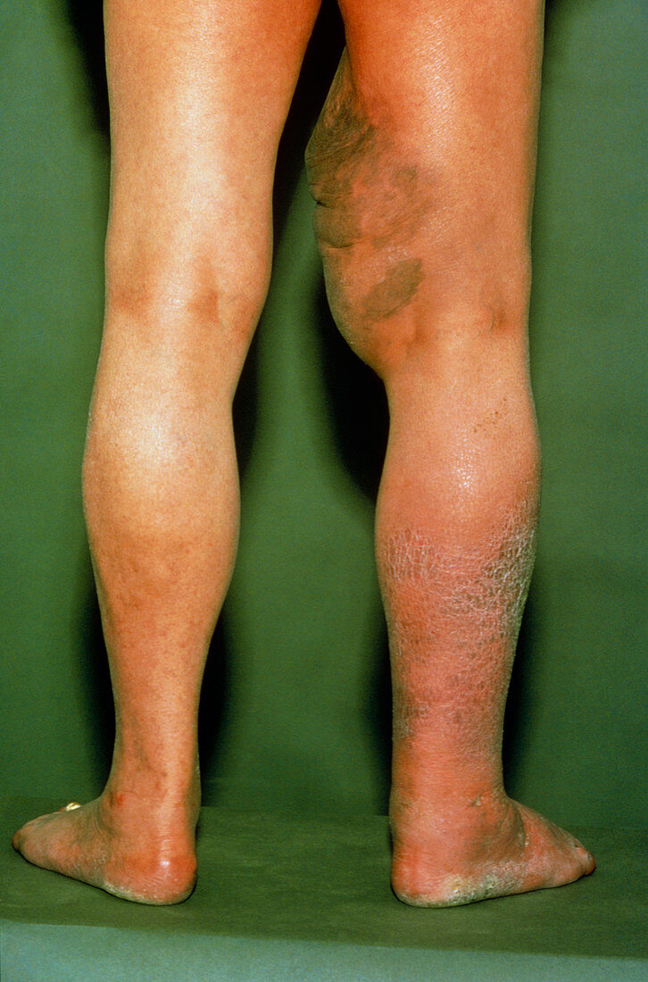 Thrombosis in leg