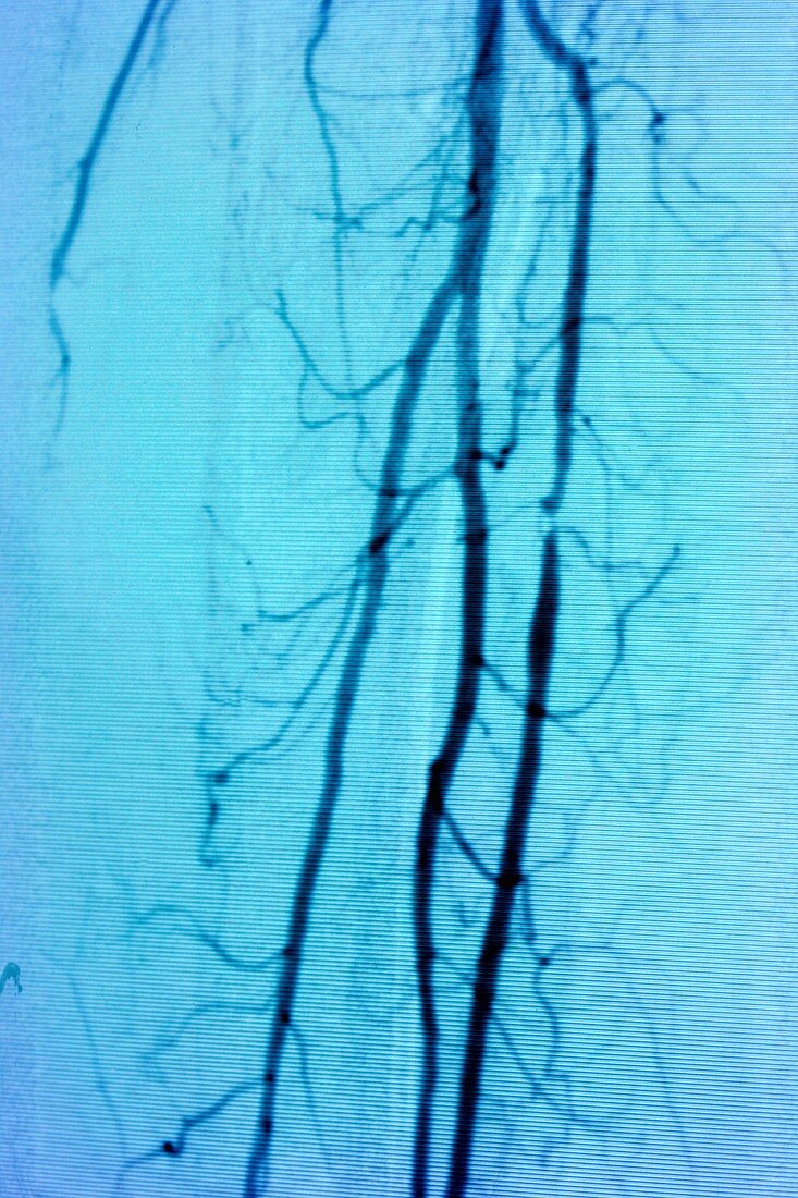 Stenosis of leg vessels,angiogram