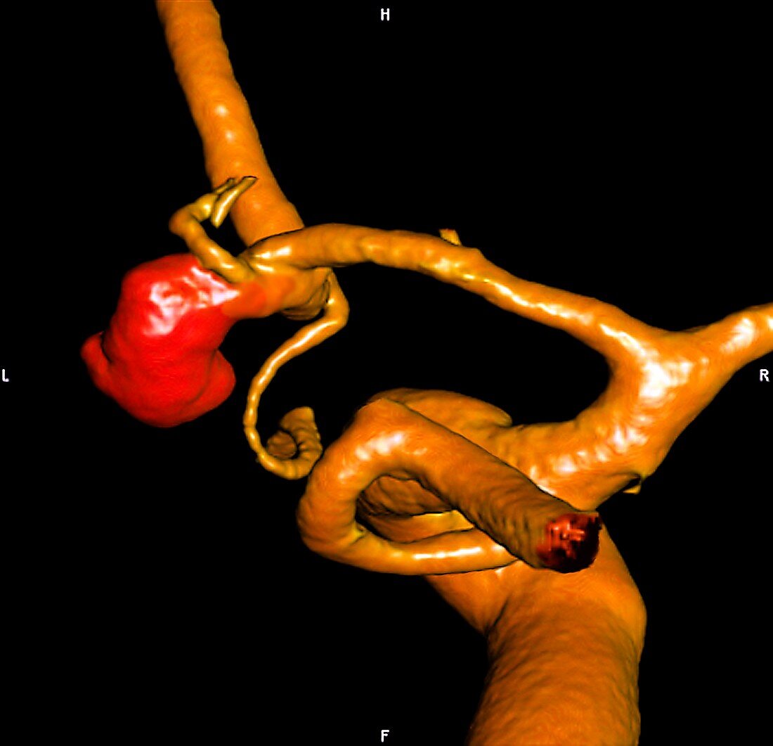 Carotid aneurysm,angiogram