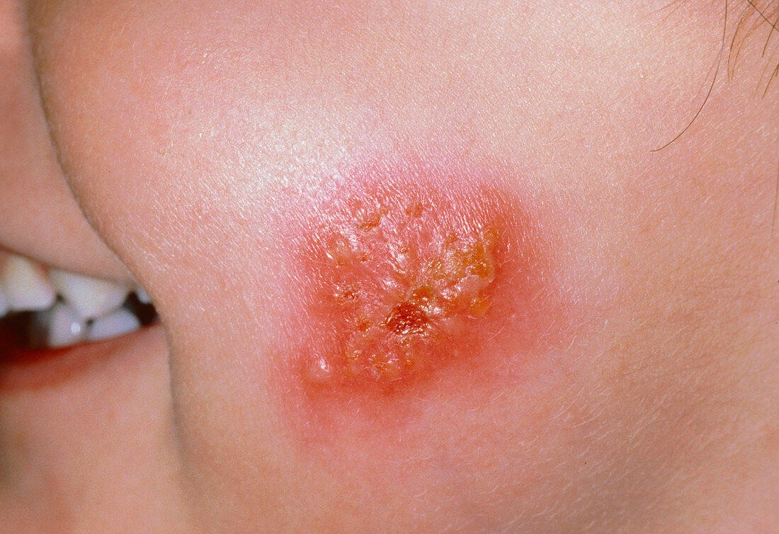 Impetigo lesion on a child's cheek