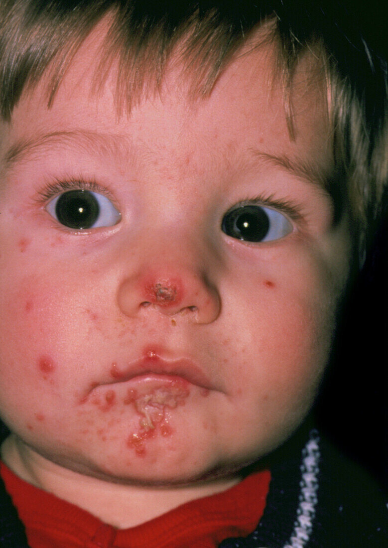 Impetigo sores on the chin of an infant