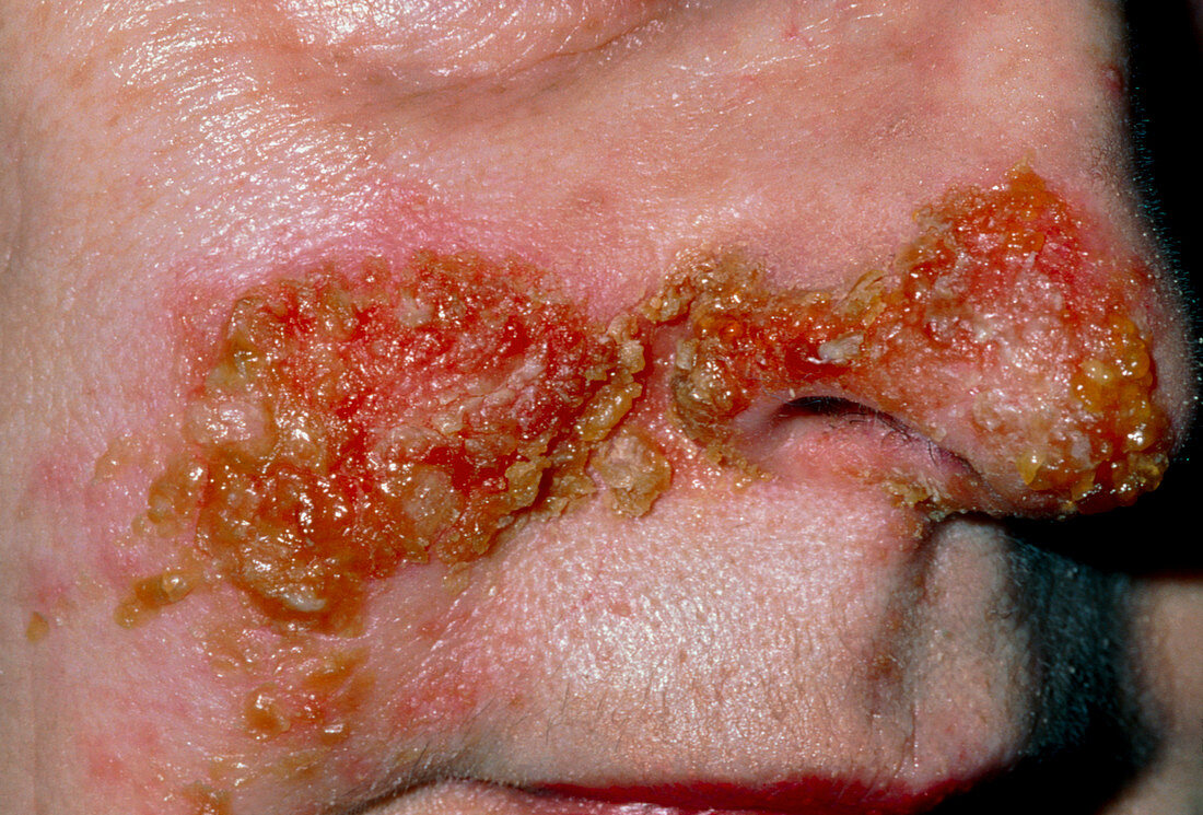 Impetigo on woman's face,secondary to herpes S