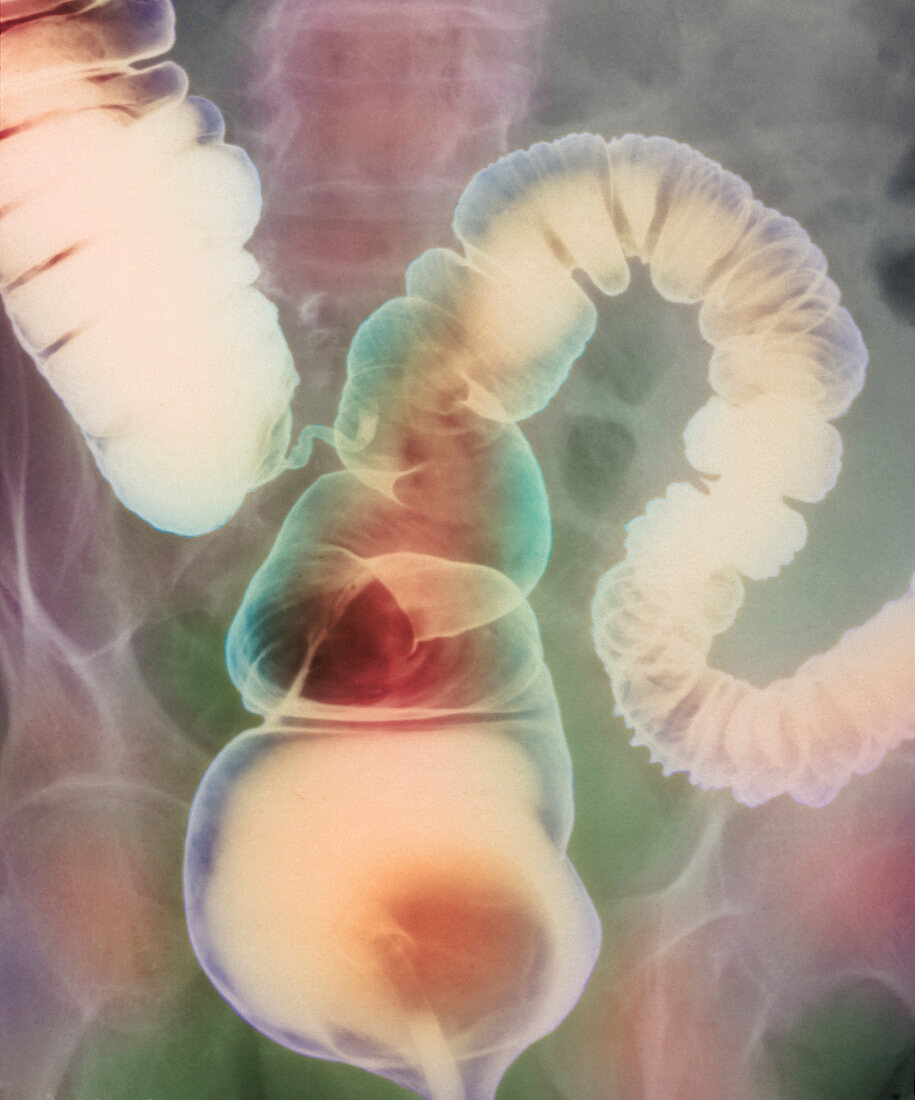 Irritable bowel syndrome,X-ray