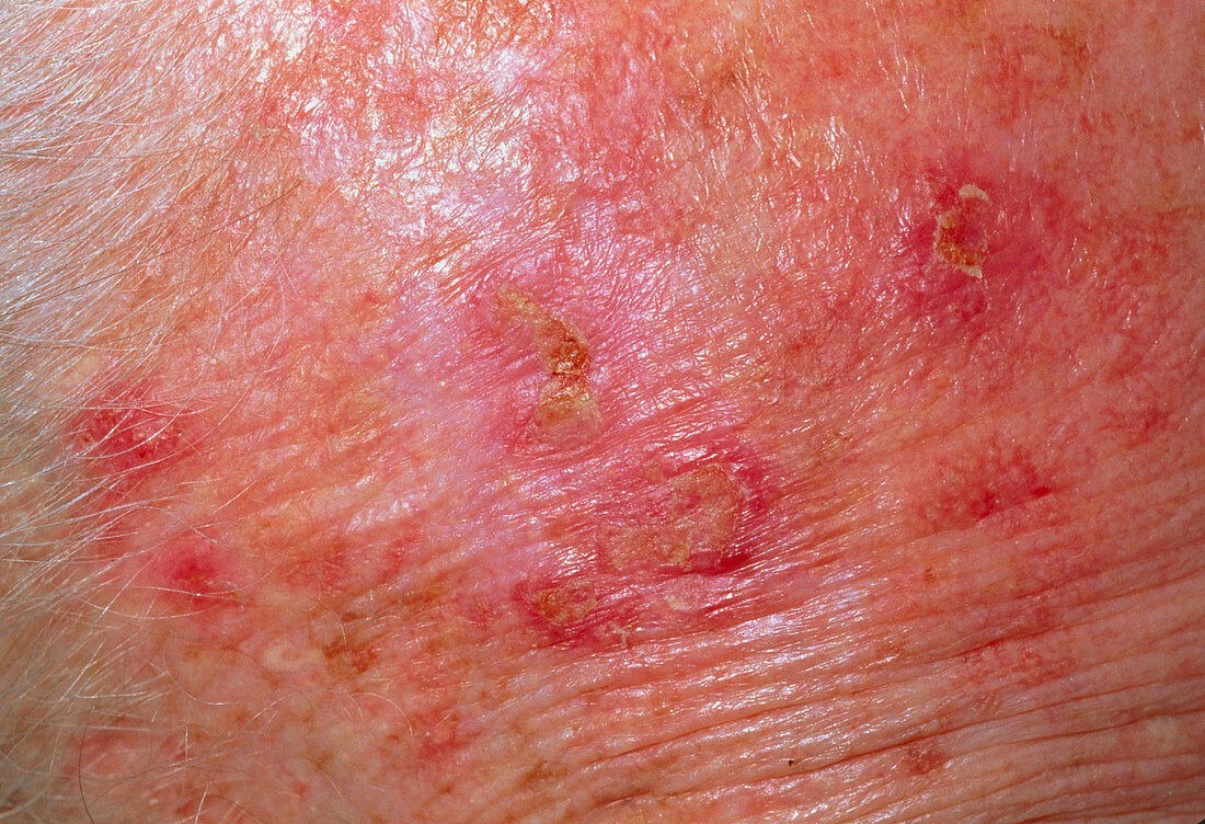 Solar keratosis skin disorder