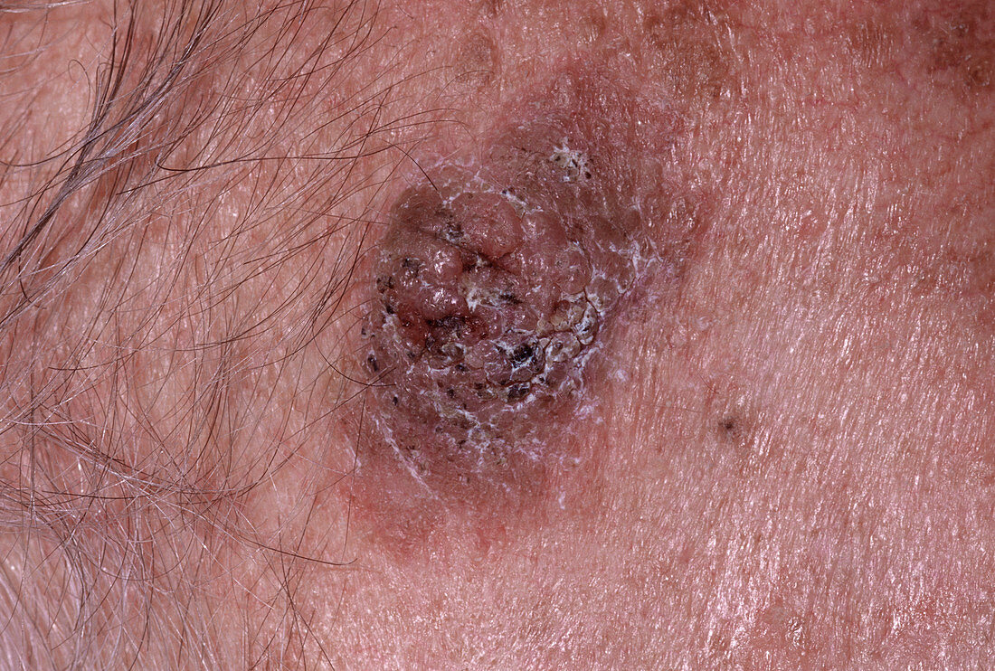 Seborrhoeic wart