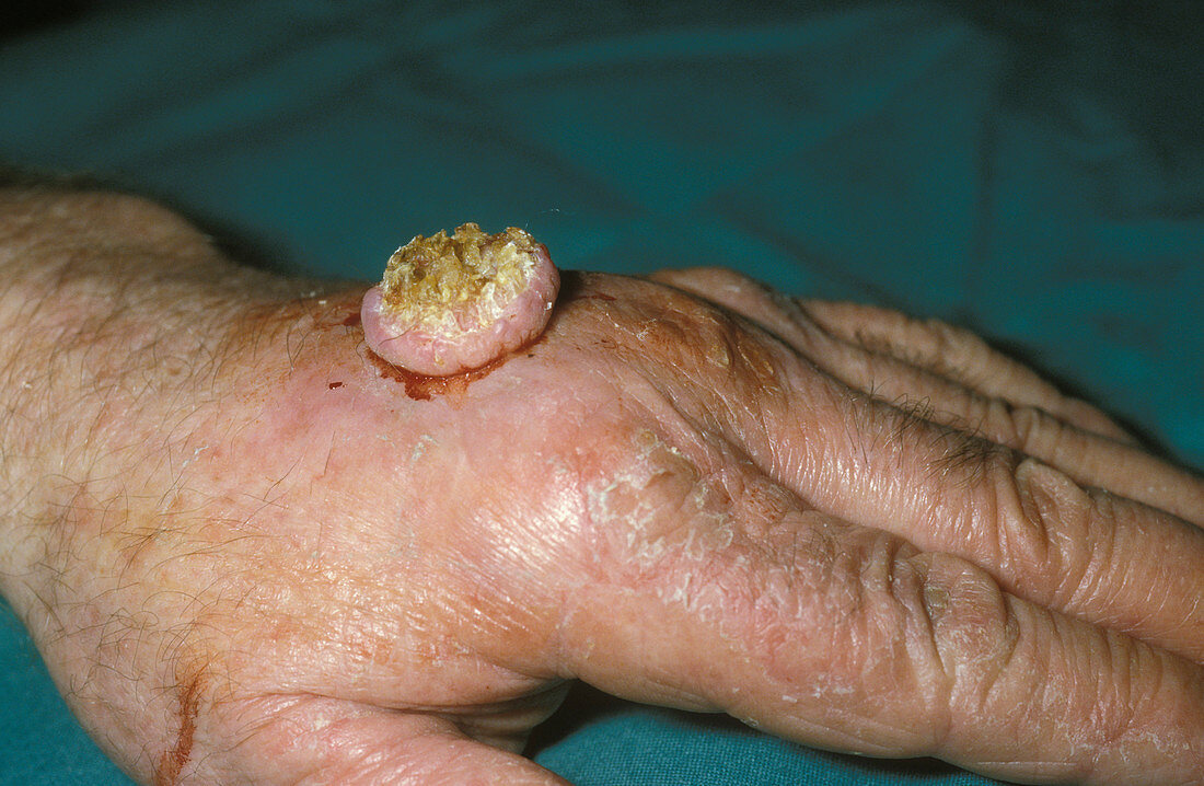 Skin nodule