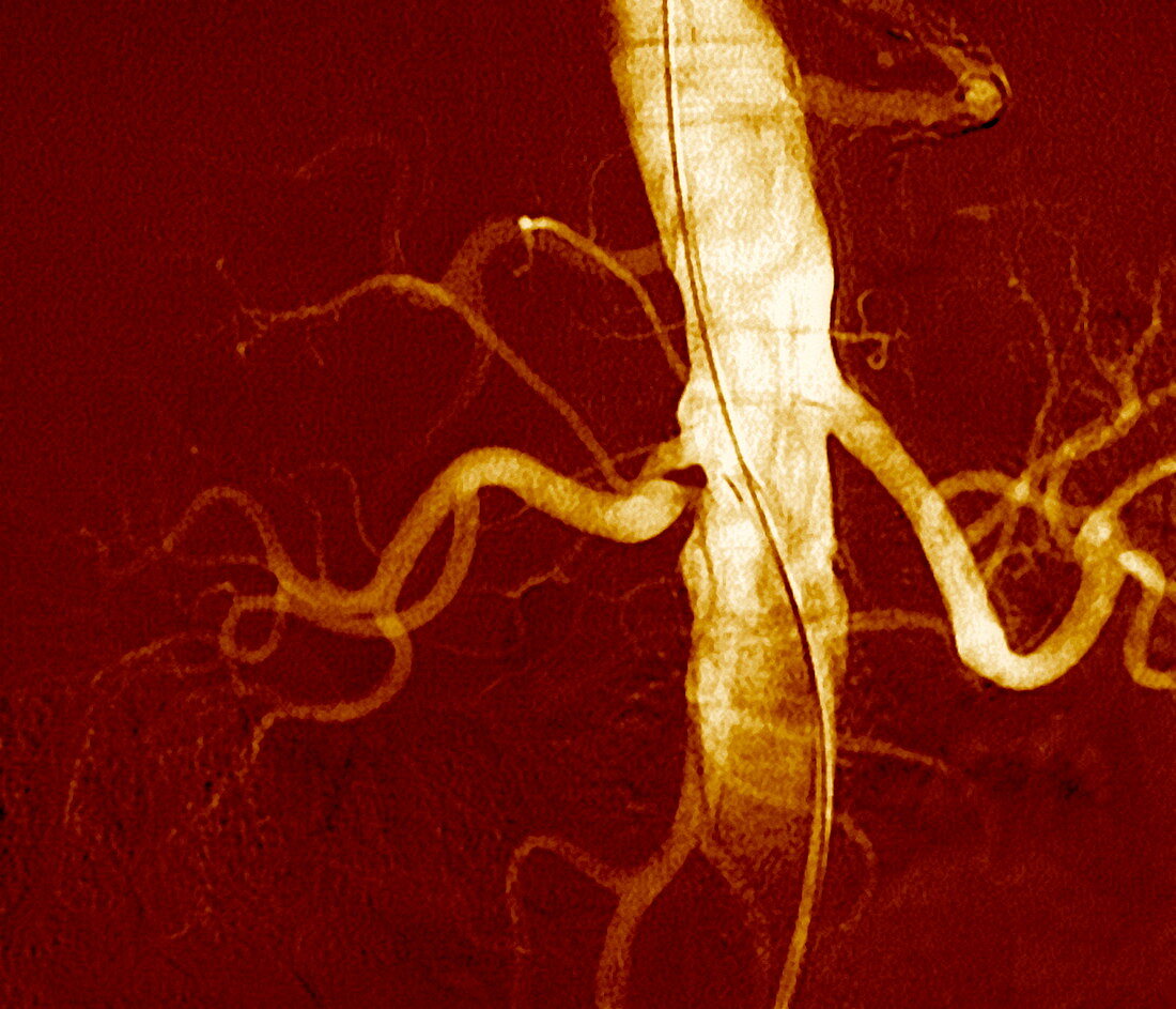 Narrowed renal artery,X-ray