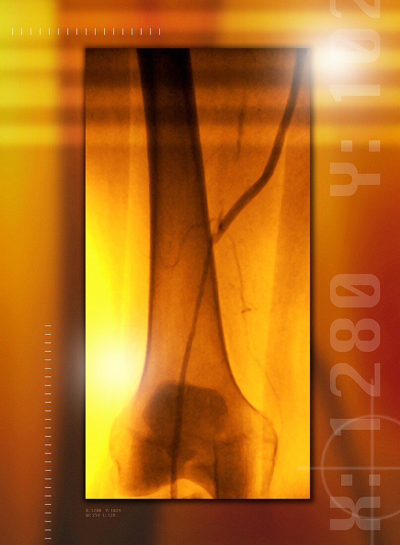 Femoral artery bypass,angiogram X-ray