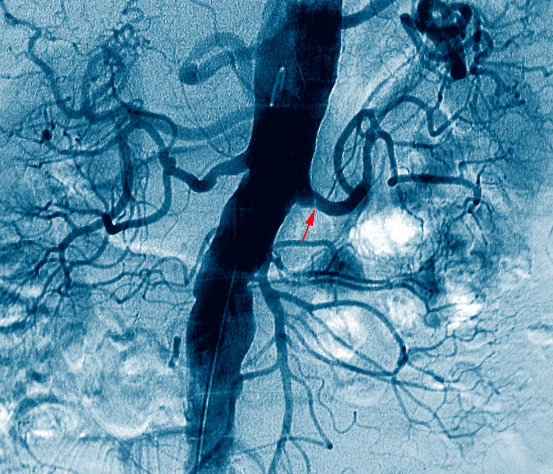 Narrowed renal artery,X-ray