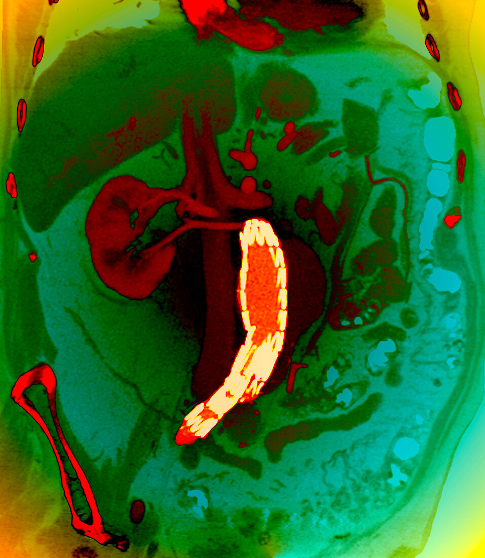 Abdominal aortic aneurysm,CT scan