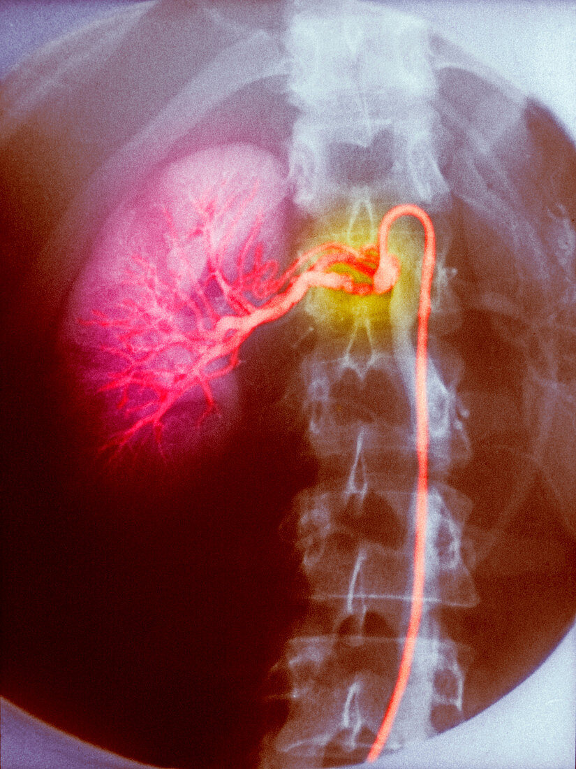 Narrowing of renal artery,X-ray